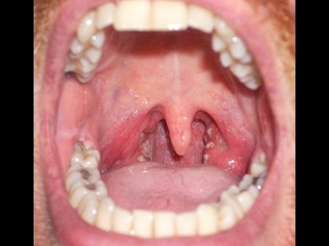 Sore Throat or Strep Throat, How Do I Know?https://www.royonrescue.com/wp-content/uploads/2013/10/sore-throat.jpg